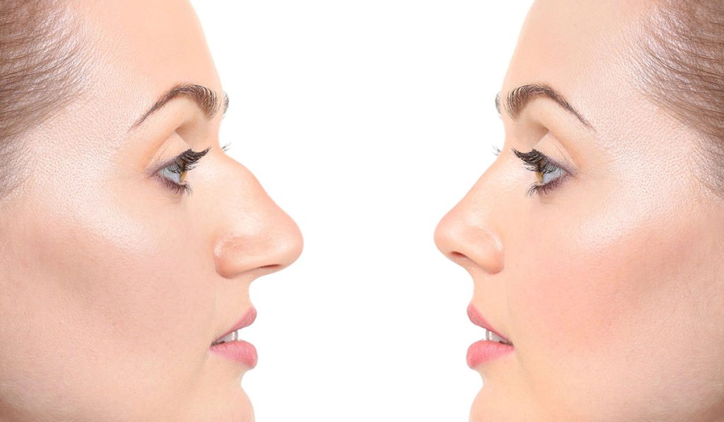 تعرف على إجابة سؤال متى يتحسن التنفس بعد عملية تجميل الأنف؟ وتعرف أيضًا على أنواع عمليات تجميل الأنف