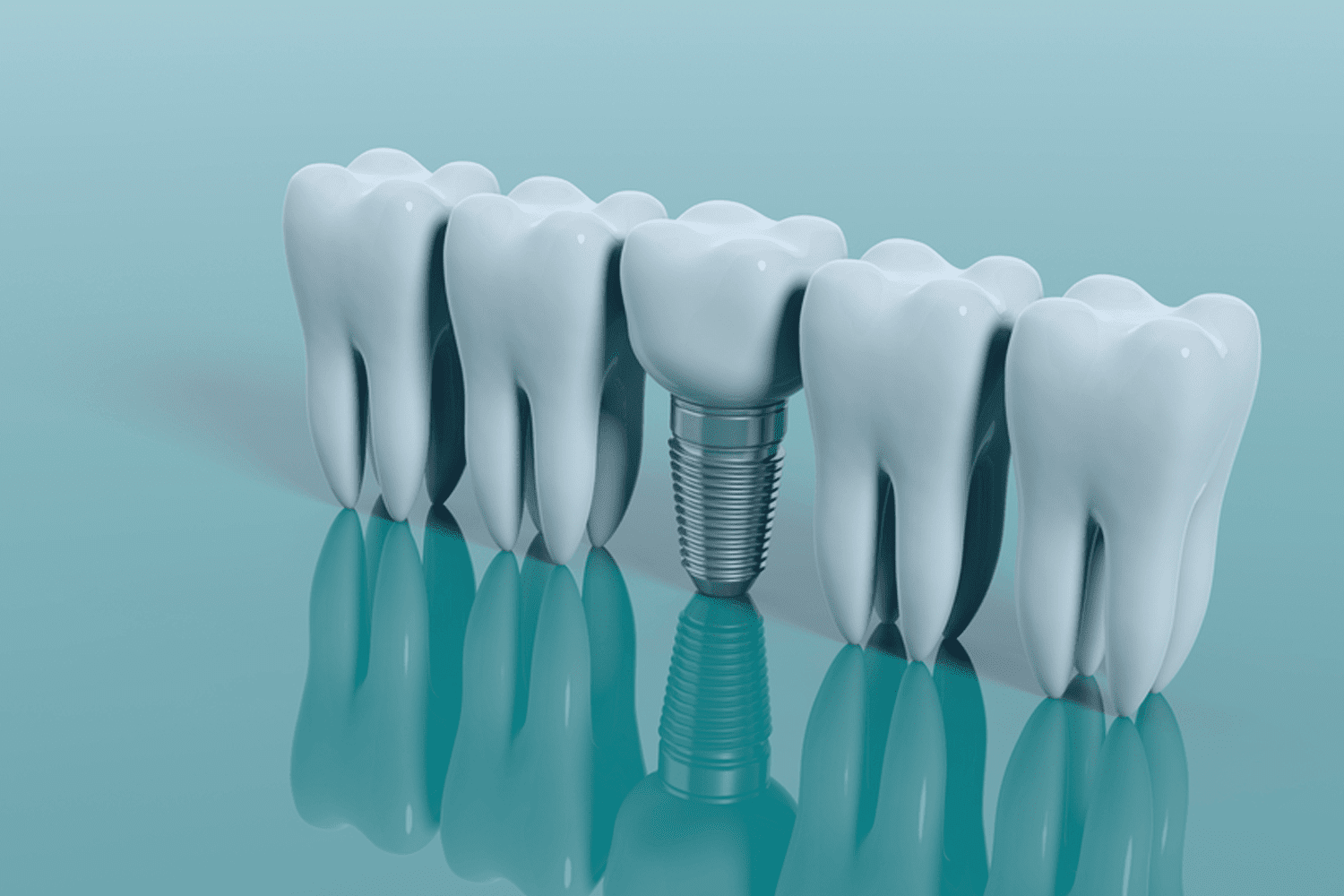 زراعه الأسنان