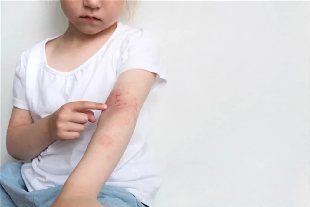 الصدفية عند الاطفال