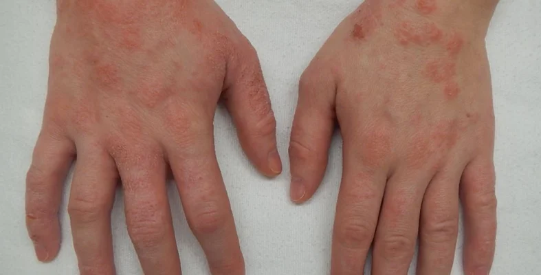 أفضل علاج للإكزيما