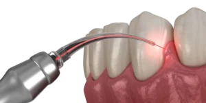 عملية تجميل اللثة بالليزر