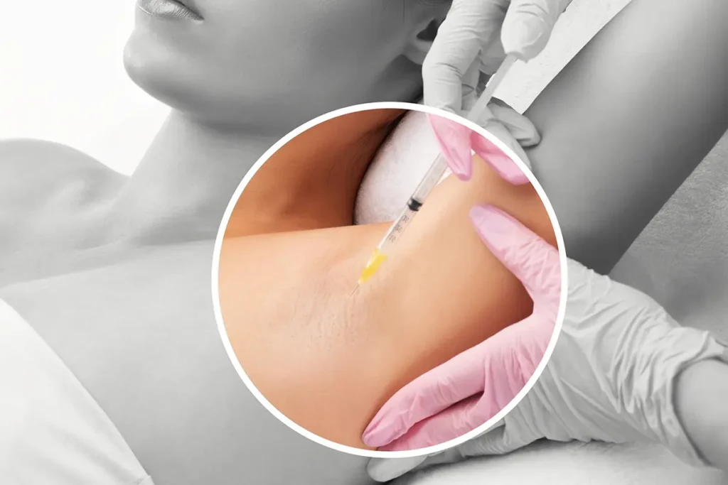 إبرة البوتكس للتعرق: الحل الفعّال للتخلص من التعرق الزايد 1 إبرة البوتكس للتعرق علاج فعّال للتعرق