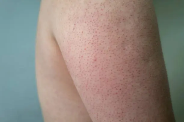 التخلص من جلد الوزة في المناطق الحساسة