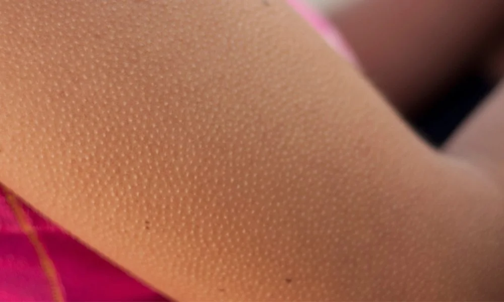 التخلص من جلد الوزة في المناطق الحساسة 1 التخلص من جلد الوزة في المناطق الحساسة